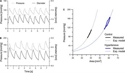 Subject-Specific Pressure Normalization of Local Pulse Wave Velocity: Separating Intrinsic From Acute Load-Dependent Stiffening in Hypertensive Patients